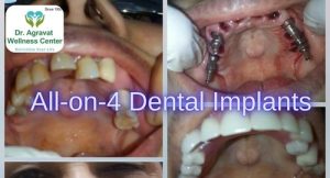 All on 4 Dental Implants Cost, Procedure, Benefits at Dr Agravat Dental Clinic Implants Wellness Center in Ahmedabad, Gujarat, India