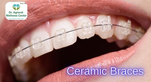 Ceramic Braces Treatment Cost, Procedure, Benefits at Dr Agravat Dental Clinic Implants Wellness Center in Ahmedabad, Gujarat, India