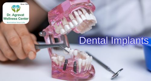 Dental Implants Cost, Procedure, Benefits at Dr Agravat Dental Clinic Implants Wellness Center in Ahmedabad, Gujarat, India