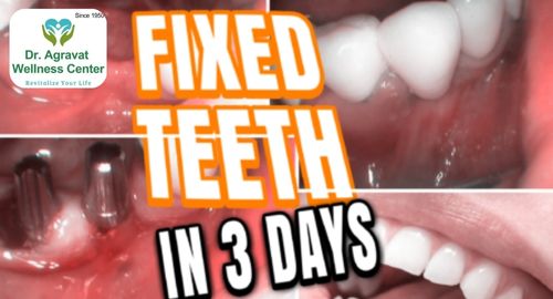 Fixed Teeth in 3 Days Cost, Procedure, Benefits at Dr Agravat Dental Clinic Implants Wellness Center in Ahmedabad, Gujarat, India