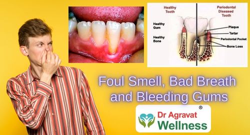 Foul Smell, Bad Breath and Bleeding Gums reatment Cost, Procedure, Benefits at Dr Agravat Dental Clinic Implants Wellness Center in Ahmedabad, Gujarat, India
