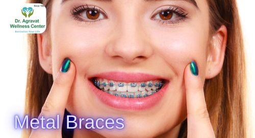 Metal Braces Treatment Cost, Procedure, Benefits at Dr Agravat Dental Clinic Implants Wellness Center in Ahmedabad, Gujarat, India