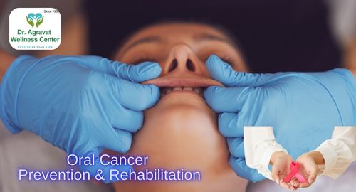 Oral Cancer Prevention and Rehabilitation Treatment Cost, Procedure, Benefits at Dr Agravat Dental Clinic Implants Wellness Center in Ahmedabad, Gujarat, India