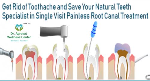Single Visit Painless Root Canal Treatment Dr Agravat Wellness Center Ahmedabad-Gujarat-India