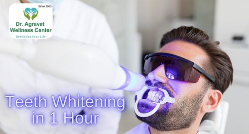 Teeth Whitening in 1 hour Cost, Procedure, Benefits at Dr Agravat Dental Clinic Implants Wellness Center in Ahmedabad, Gujarat, India