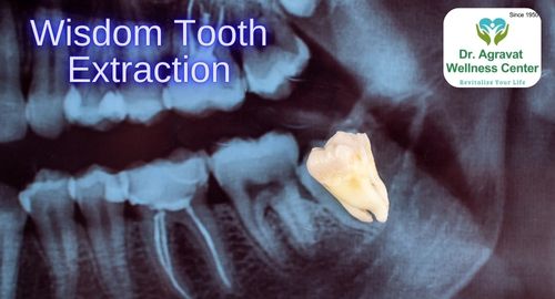 Wisdom Tooth Extraction Cost, Procedure, Benefits at Dr Agravat Dental Clinic Implants Wellness Center in Ahmedabad, Gujarat, India