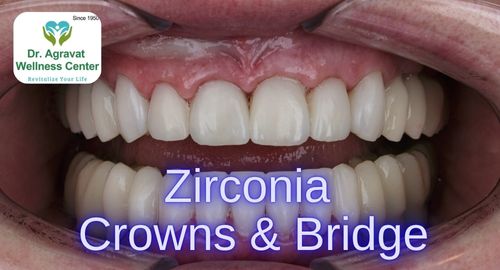 Zirconia Crown and Bridges Types, Cost, Procedure, Benefits, and Care at Dr Agravat Dental Clinic Implants Wellness Center in Ahmedabad_Gujarat, India