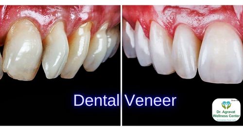 Dental Veneer Cost, Procedure, Benefits at Dr Agravat Dental Clinic Implants Wellness Center in Ahmedabad, Gujarat, India